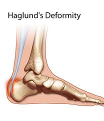 Radiographic evaluation of haglund's deformity. Haglund S Syndrome