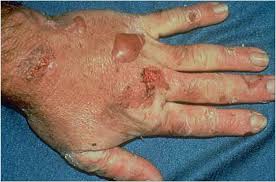 Resultado de imagen para hepatitis b