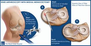 Admitted Knee Arthroscopy Orthopedics Orthopedic Surgery