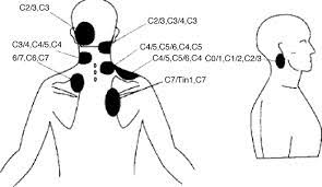 Now, without moving your shoulders, try to push the head back, as if you are trying to make a double chin. Cervical Facet Joint Dysfunction A Review Archives Of Physical Medicine And Rehabilitation