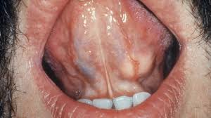 In recent research studies conducted by the national cancer institute, a link between blood tests to detect the possibility of throat cancer has been found. What Is The First Stage Of Throat Cancer Youtube