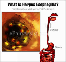 Pit pattern in colorectal neoplasia: What Is Herpes Esophagitis How Is It Treated Causes Symptoms Of Herpes Esophagitis