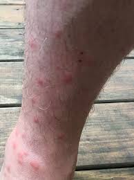 Flea bites are harmless, and will go away on their own. Flea Bites On My Husband S Ankles And Calf S After A Night At The Hotel Picture Of The Kimpton Brice Hotel Savannah Tripadvisor
