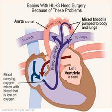Hypoplastic Left Heart Syndrome Surgery The Norwood Procedure For Parents Nemours Kidshealth