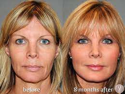 As skin ages, it becomes thinner and separates from the underlying muscles and fats, causing a saggy appearance. The Y Lift Face Lift Procedure Phoenix Skin Y Lift Before And After Y Lift Phxskin 4 Face Lift Surgery Lower Face Lift Surgery Facial Fillers