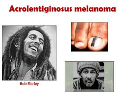 A diagnosis of melanoma in 1977, bob marley was diagnosed with malignant melanoma, a kind of skin cancer, after doctors found a lesion on a toe he'd injured in a soccer game. Bob Marley Hemi Ded Blong Skin Cancer Yu Tu Mus Luk Aot Long Sun Se Fram Hemi Save Burnem Yu Big Wan Sista