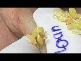 Satisfying With Loan Nguyen Spa Video 006 Youtube In 2021 Popping Blackheads Youtube Videos Blackheads Popping Pimple Popping