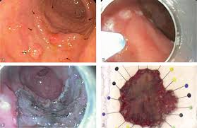 By stage iv, the cancer is considered advanced and may have spread to other areas of the body. Scielo Brasil Initial Experience Of Endoscopic Submucosal Dissection In Brazil To Treat Early Gastric And Esophagheal Cancer Initial Experience Of Endoscopic Submucosal Dissection In Brazil To Treat Early Gastric And