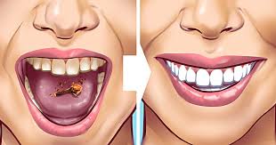 In case the plaque is not removed by regular brushing, it can harden. 10 Ways To Remove Tartar Stains From Your Teeth