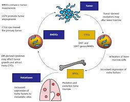Several types of cancer, including multiple myeloma, leukemia, and lymphoma, can develop in the bone marrow. Recent Aspects For Disseminated Carcinomatosis Of The Bone Marrow Associated With Gastric Cancer What Has Been Done For The Past And What Will Be Needed In Future