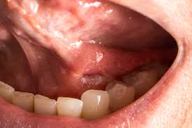 Image result for cancer tongue symptoms)