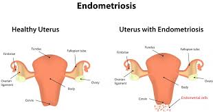 The tissue is commonly found on the ovaries, supporting ligaments of the uterus, and in the cavities of the pelvis. What Is Endometriosis