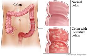 Image result for Ulcerative Colitis