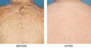 Laser hair removal queens new york. Laser Hair Removal New York City Laser Defoliation Manhattan Nyc