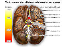 Aneurysmal bleeding often collects within an most will not have symptoms or problems. Intracranial Aneurysm Wikipedia