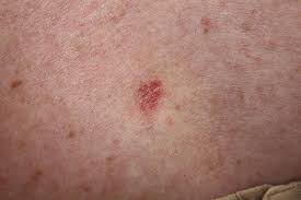 Basal Cell Carcinoma Pictures