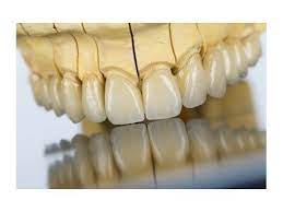 Porcelain Fused To Metal Crowns Has Been Considered The Gold Standard For The Repair Of Damaged Teeth Pfm Crowns Have Goo Dental Restoration Dental Lab Dental