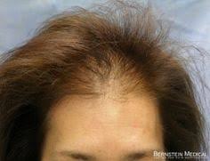 Slowly work your way towards the front of your scalp (the hairline). 21 Female Hair Transplants Ideas Hair Transplant Hair Transplant Women Transplant