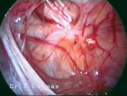 A laparoscopy is the most common way to diagnose endometriosis. Peritoneal Endometriosis Eugonia