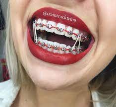 If rubber band is not worn as instructed teeth constantly rellaps t. Bild Konnte Enthalten Eine Oder Mehrere Personen Und Nahaufnahme Braces Colors Braces Teeth Colors Cute Braces Colors
