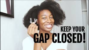 In this solution, dental rubber bands are used around your teeth at night to physically pull them watch how dental bonding helps with the gap: The Retainer To Keep Your Gap Closed How To Close Your Gap With Rubber Bands Youtube