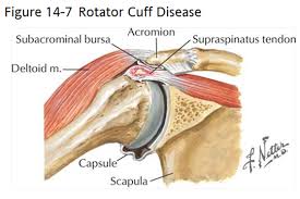 An overview of a supraspinatus tendon tear. Shoulder Anatomy Supraspinatus Tendon Learn Muscle Anatomy Of Dads And Rotator Cuff Injuries Shoulder Tendonitis Goes Beyond Everyday Shoulder Pain Violetap Sixty
