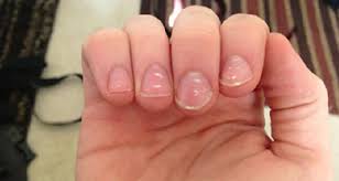 White Nail Spots What It Mean White Spots On Nails White Marks On Nails White Spots On Fingernails