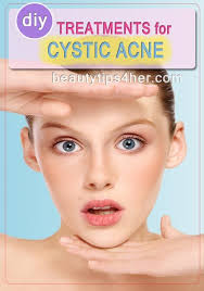 Diy Treatments For Cystic Acne Beauty And Makeup Tips Diy Acne Treatment Cystic Acne Diy Treatment