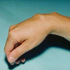 Ganglion An Hand Handgelenk Und Fingern