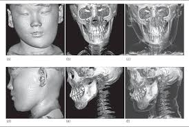 Image result for periostitis