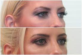 Upper Eyelid Surgery Blepharoplasty Eyelid Eyelift Uppereyelid Uppereyelidsurgery Eye Lazyeye Droopyeye Facial Aesthetics Cosmetics Laser Droopy Eyes