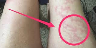 The rashes tended to appear in younger people and lasted. Unusual Skin Symptoms Of Coronavirus Covid Toes Blisters Business Insider