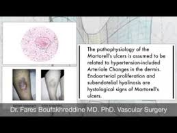 Martorell hypertensive ischemic ulcer can be a real clinical and therapeutic challenge. Martorell S Ulcers Youtube