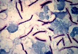 Image result for Anthrax