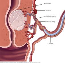 Less than one in a thousand cases of fibroids develop into cancer 9). Uterine Fibroids Diagnosis And Treatment Mayo Clinic