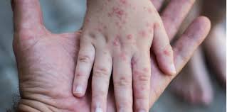 Jangkitan kulat lain pada kulit adalah histoplasmosis. Penyakit Kulit Bayi Ini Antara Jenis Yang Sering Berlaku Pada Bayi