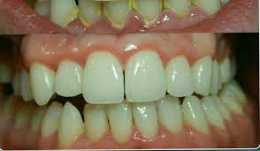 Maybe you would like to learn more about one of these? How To Get Rid Off Tartar And Plaque Istanbul Dental Care