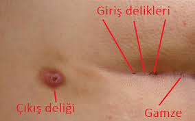 Kil Donmesi Nedir Belirtileri Nelerdir Nasil Gecer