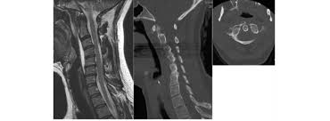 This curve is a physically desirable trait for humans to have, as if you were to lose this natural curvature, it could lead to several physical. Mri And Ct Scans Of Another Case Showing Loss Of Cervical Lordosis Download Scientific Diagram