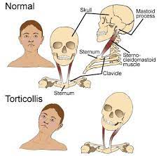 Définition du trésor de la langue française informatisé. Le Torticolis Quels Sont Les Effets Benefiques De L Osteopathie