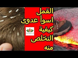 علاج سريع وفعال للقمل والصيبان youtube playbill