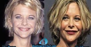 Celebrities and plastic surgery go hand in hand now. Celebrity Plastic Surgery Just Pinned To Celebrity Plastic Surgery Meg Ryan