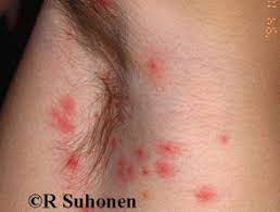 Check spelling or type a new query. Molluscum Contagiosum Images Dermnet Nz