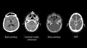 Image result for CT Head