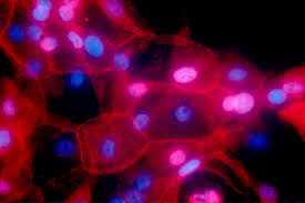 Generally, an inflammatory breast cancer rash look like like an insect bite. Who S Missing From Breast Cancer Trials Men Says The F D A The New York Times