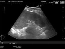 Image result for Splenomegaly