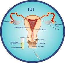 The only way to be sure whether or not iui has worked is to take a pregnancy test 14 days after the iui procedure. Iui Treatment Artificial Insemination Procedure For Pregnancy Mumbai Ankoor Fertility Clinic