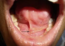 Image result for Sialoadenitis