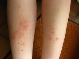 Image result for Lichen Simplex Chronicus