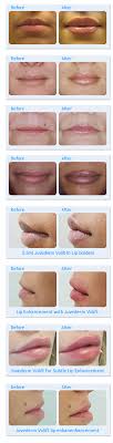 Summary of after care for lip injections. Lip Augmentation Lip Fillers In London